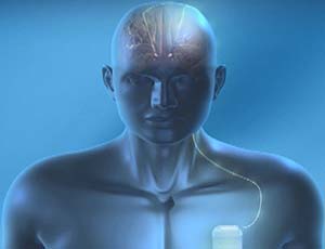Deep Brain Stimulation illustration